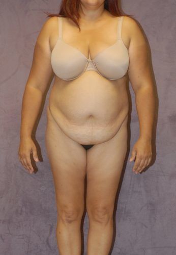 Abdominoplasty Before & After