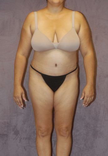Abdominoplasty Before & After