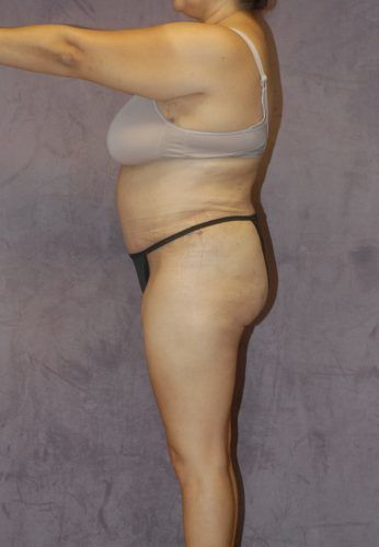 Abdominoplasty Before & After