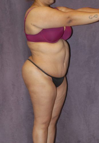 Abdominoplasty Before & After