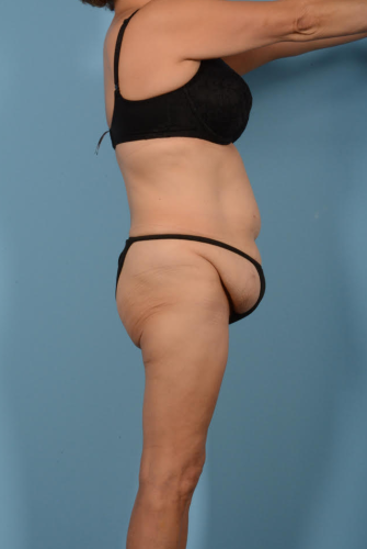 Abdominoplasty Before & After