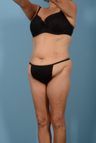 Abdominoplasty Before & After