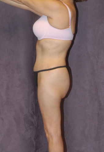 Abdominoplasty Before & After