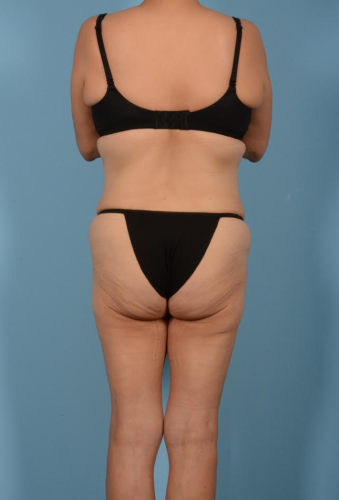 Abdominoplasty Before & After