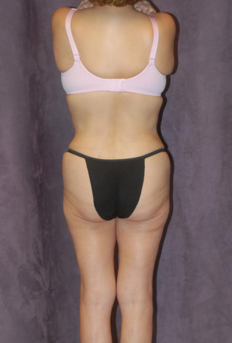 Abdominoplasty Before & After