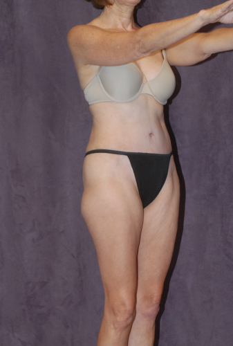 Abdominoplasty Before & After