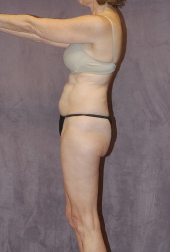 Abdominoplasty Before & After