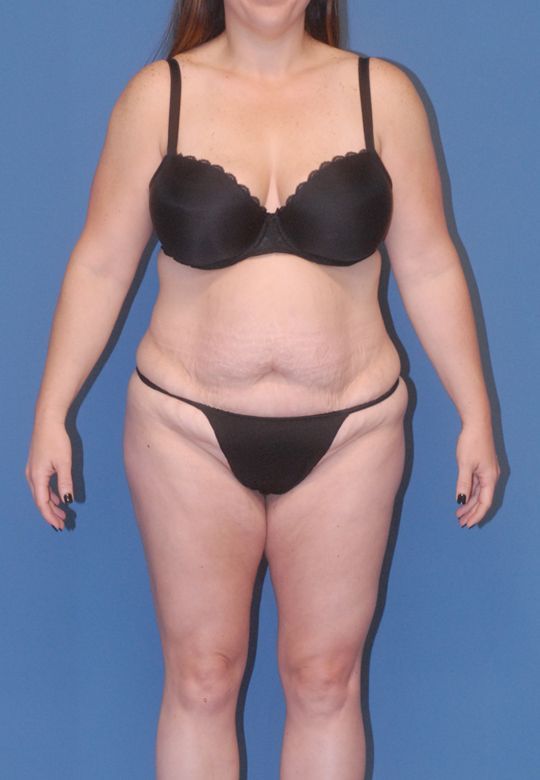 Abdominoplasty Before & After