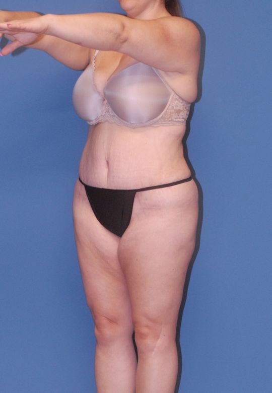 Abdominoplasty Before & After