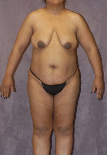 Abdominoplasty Before & After