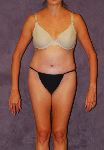 Abdominoplasty Before & After