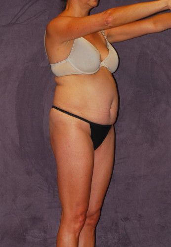 Abdominoplasty Before & After