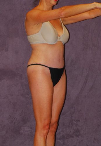 Abdominoplasty Before & After