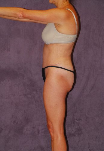 Abdominoplasty Before & After