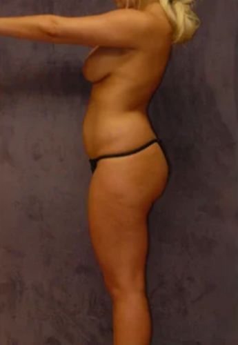 Abdominoplasty Before & After