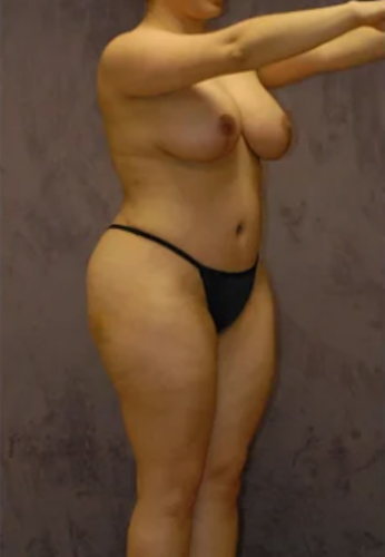 Abdominoplasty Before & After