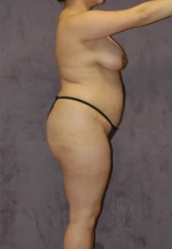 Abdominoplasty Before & After