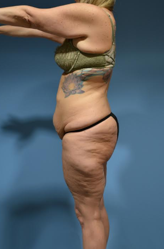 Abdominoplasty Before & After