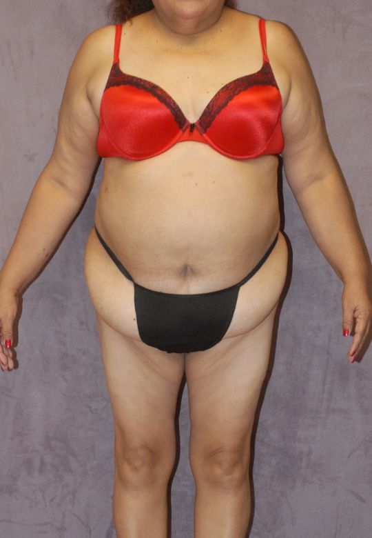 Abdominoplasty Before & After