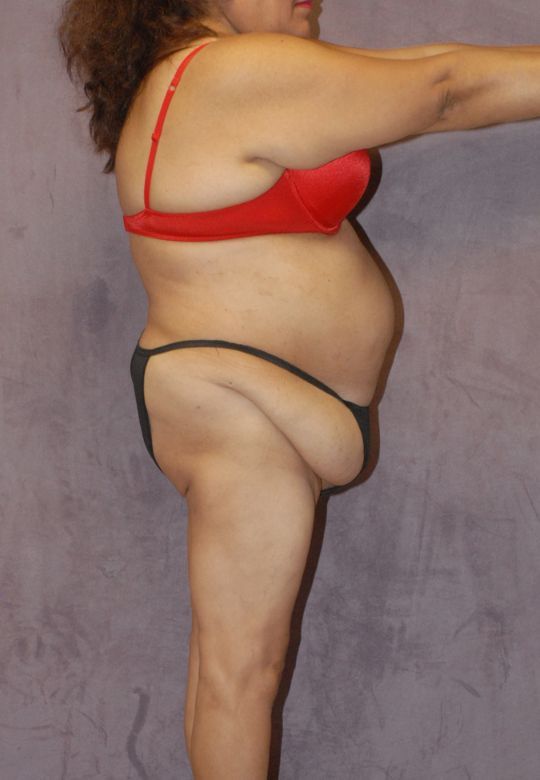 Abdominoplasty Before & After