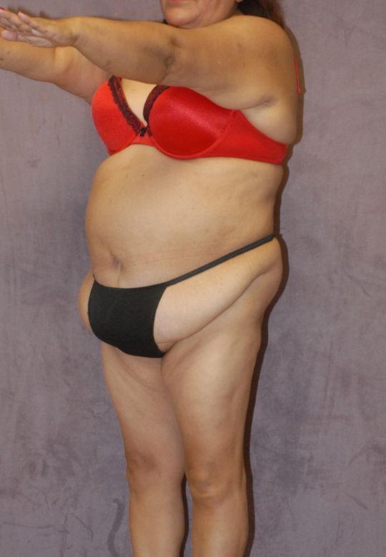 Abdominoplasty Before & After