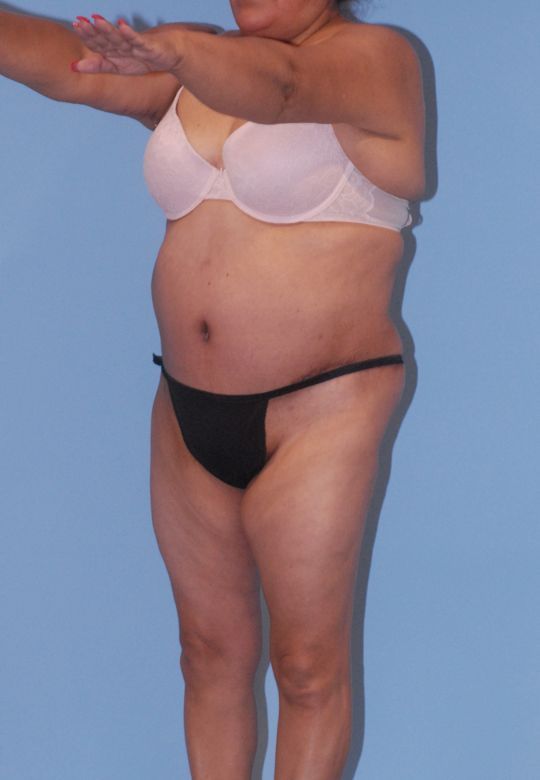 Abdominoplasty Before & After