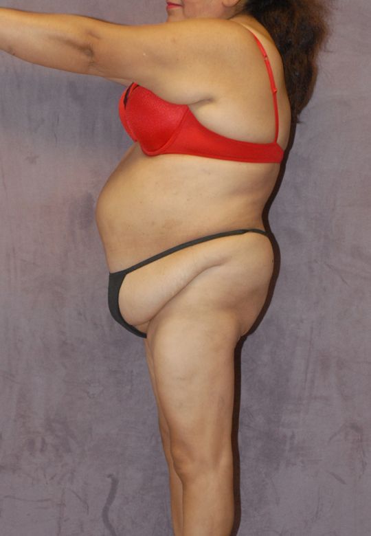 Abdominoplasty Before & After