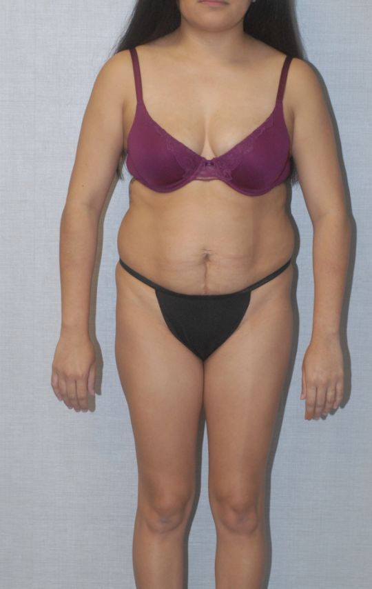 Abdominoplasty Before & After