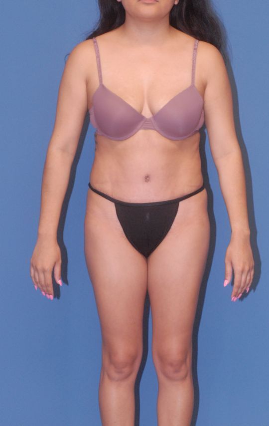 Abdominoplasty Before & After