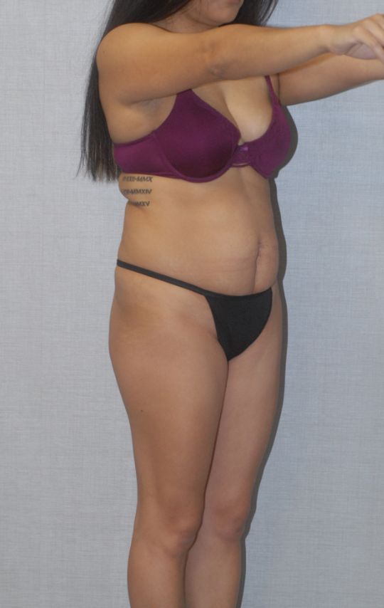 Abdominoplasty Before & After