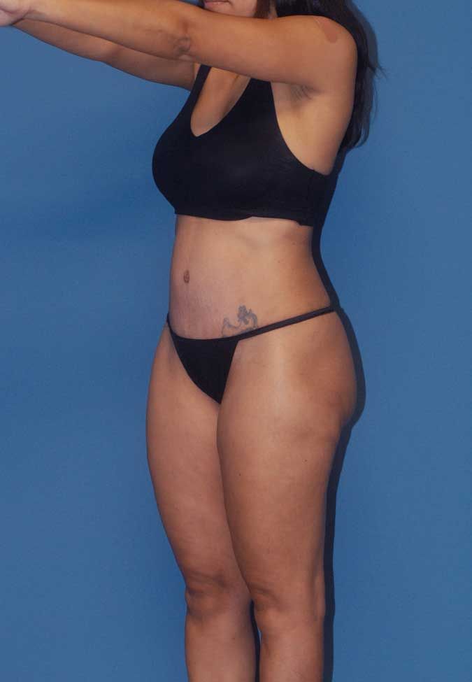 Abdominoplasty Before & After