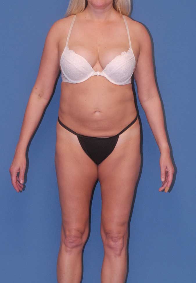 Abdominoplasty Before & After