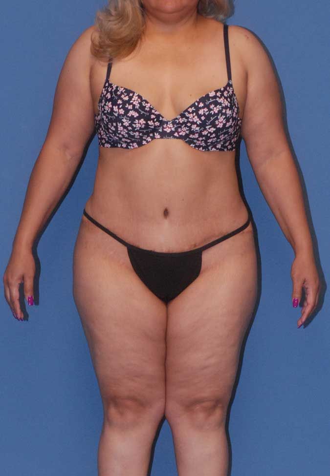 Abdominoplasty Before & After