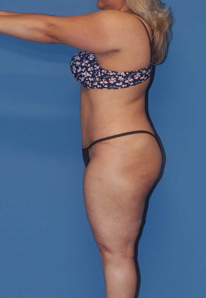 Abdominoplasty Before & After