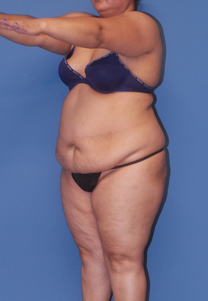 Abdominoplasty Before & After