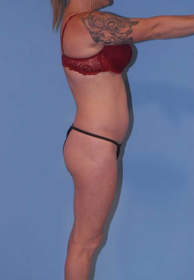 Abdominoplasty Before & After