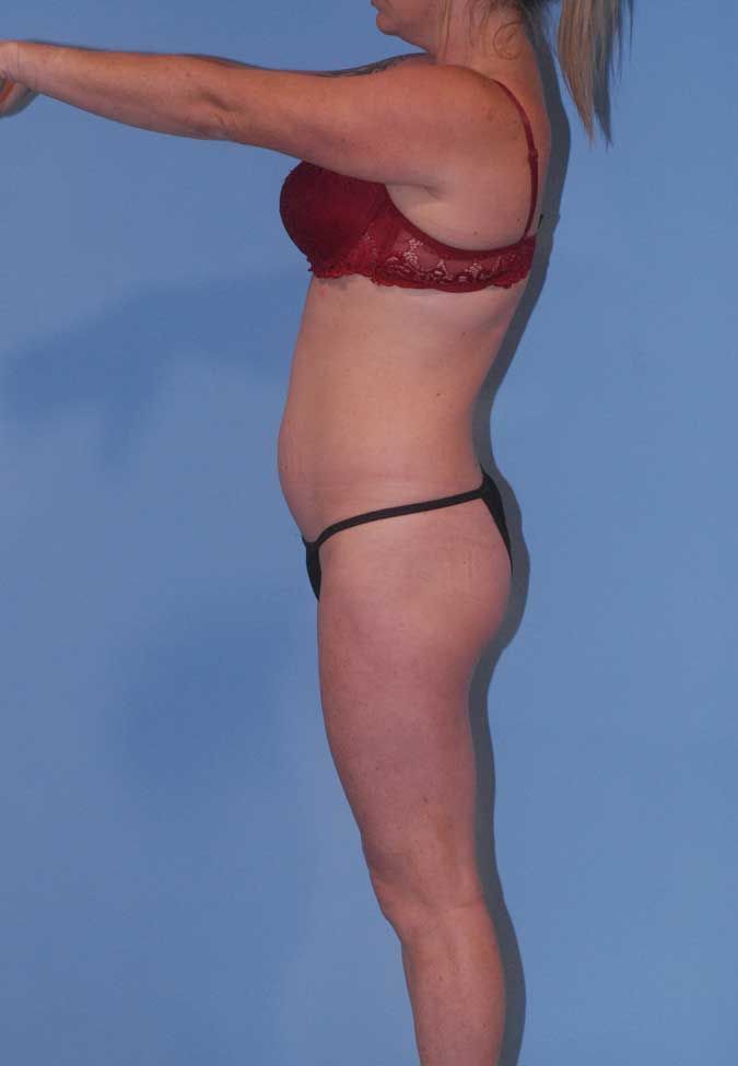 Abdominoplasty Before & After