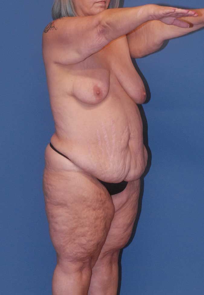 Abdominoplasty Before & After