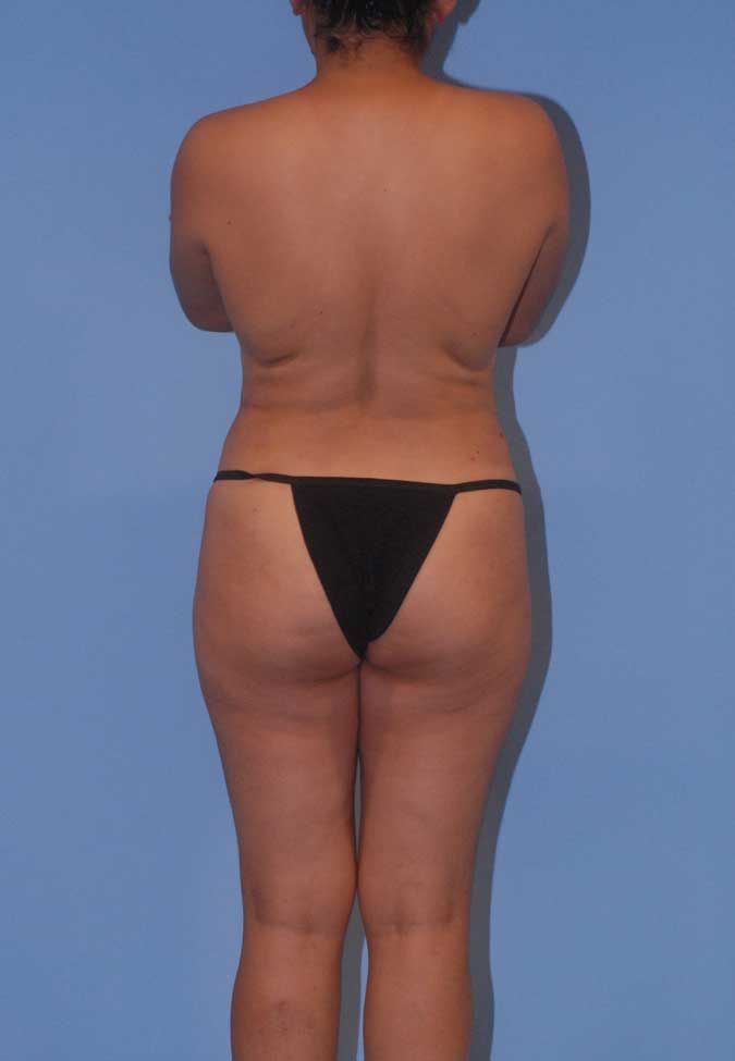 Abdominoplasty Before & After