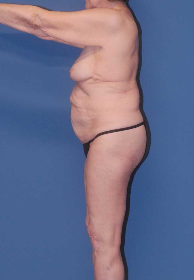 Abdominoplasty Before & After