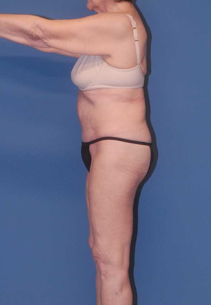 Abdominoplasty Before & After