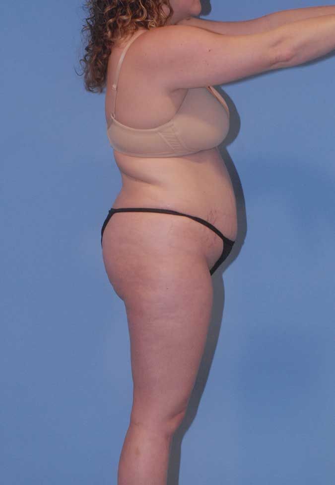 Abdominoplasty Before & After