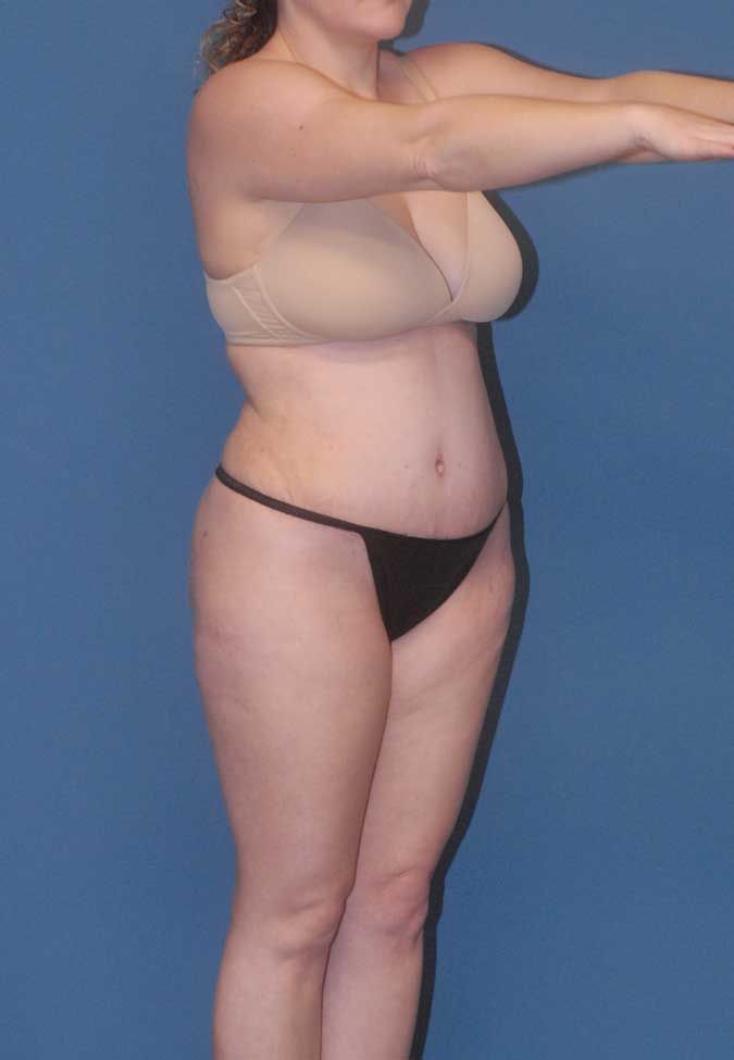 Abdominoplasty Before & After