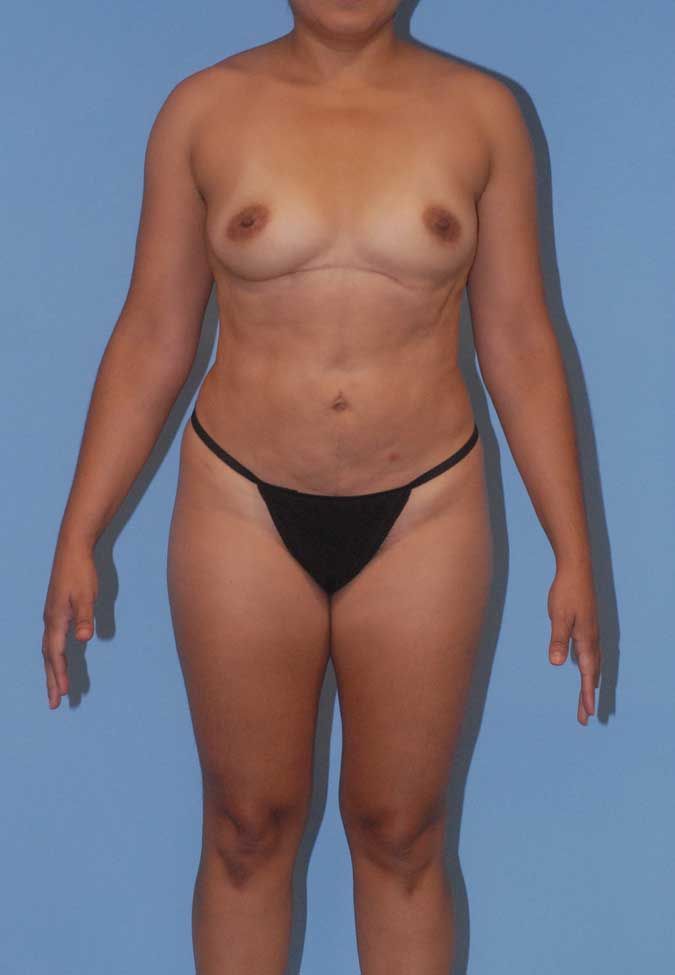 Abdominoplasty Before & After