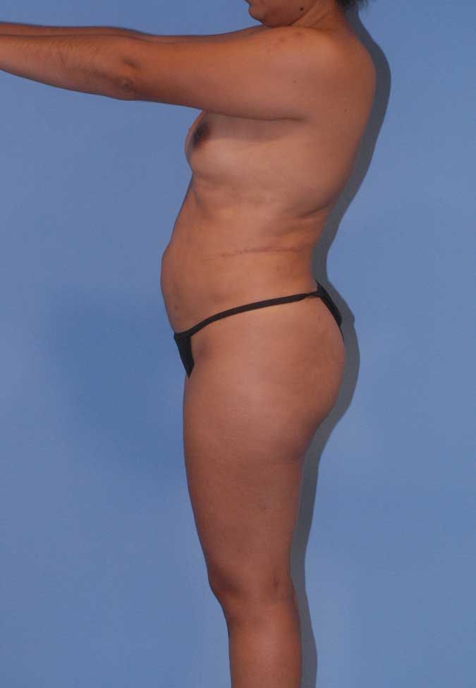 Abdominoplasty Before & After