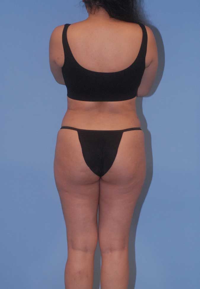 Abdominoplasty Before & After