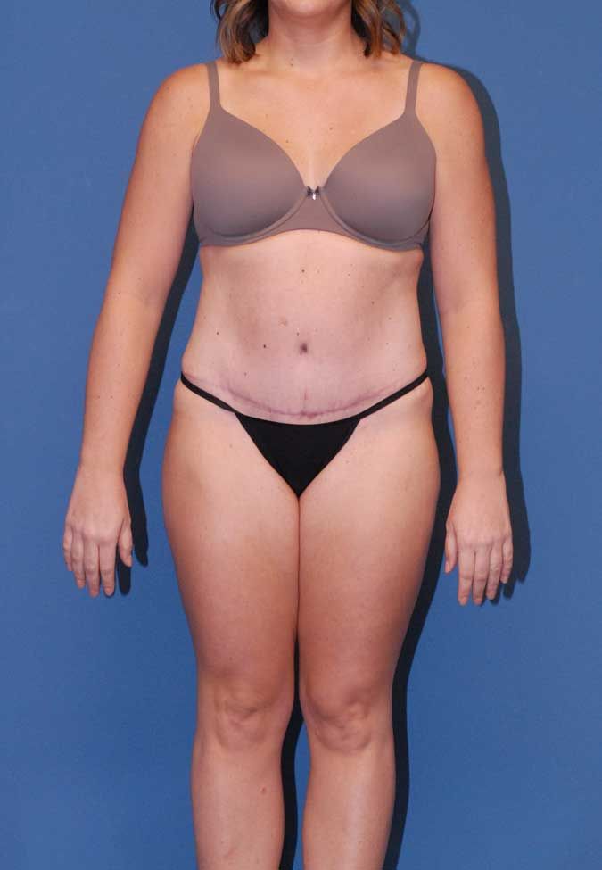 Abdominoplasty Before & After