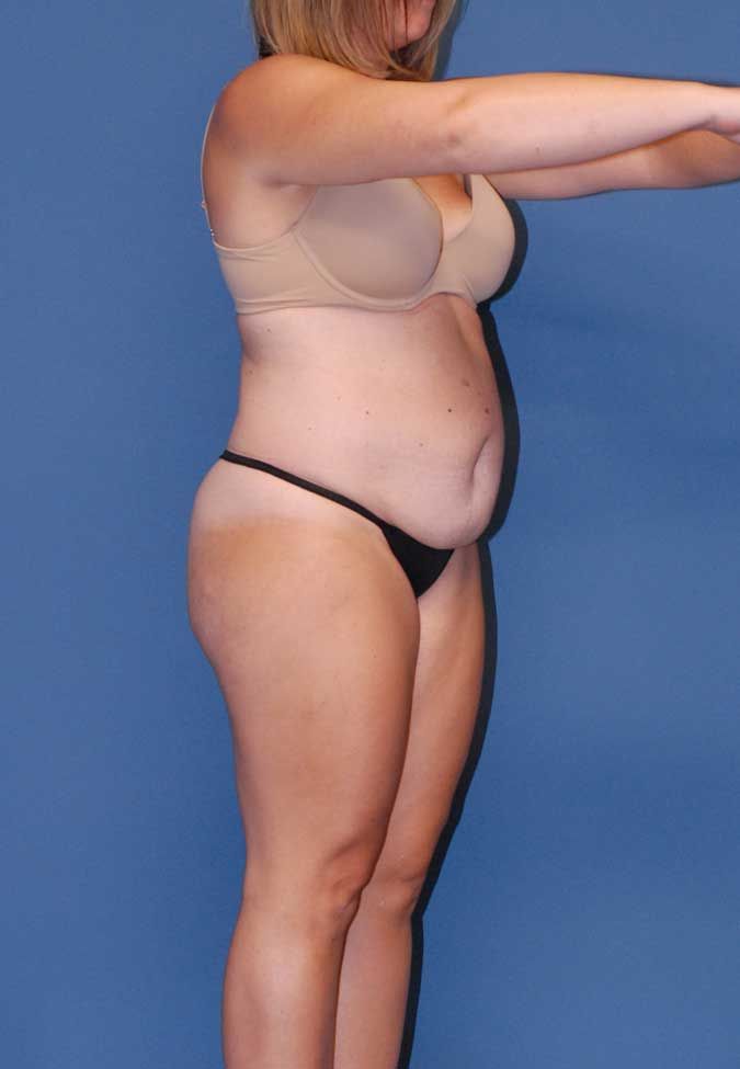 Abdominoplasty Before & After