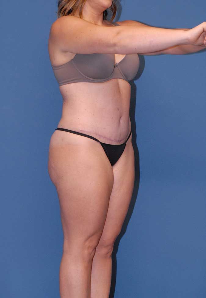 Abdominoplasty Before & After