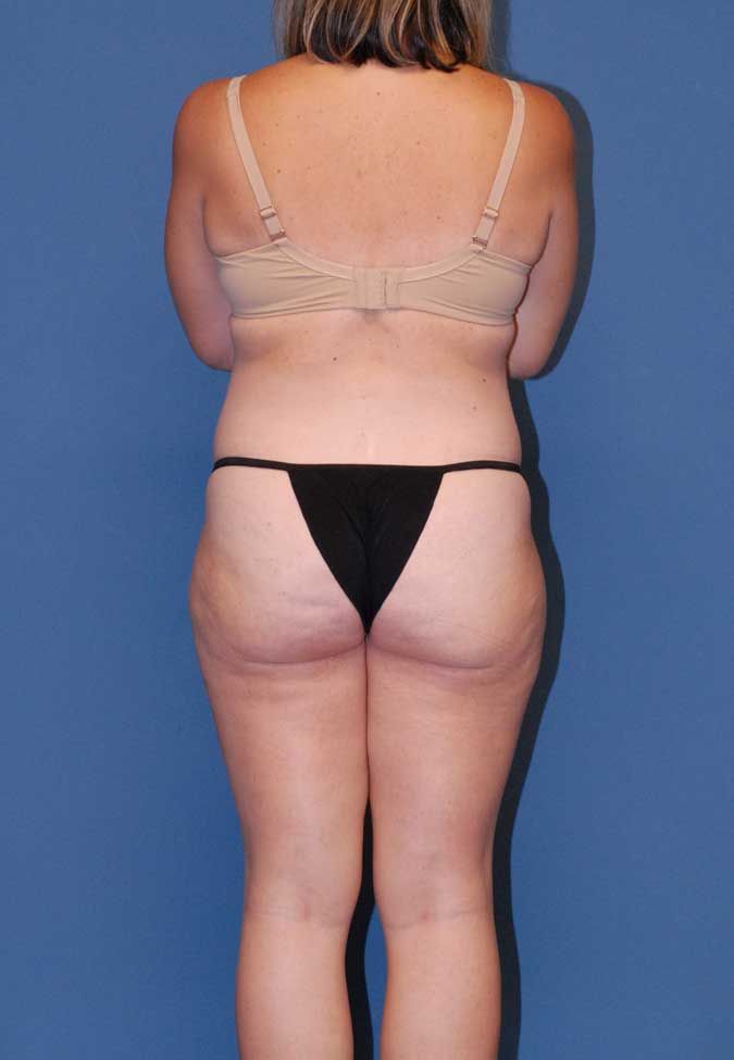 Abdominoplasty Before & After